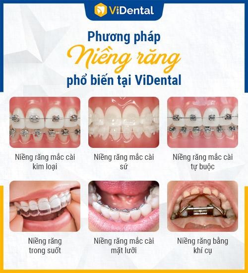 ViDental cung cấp đa dạng phương pháp niềng răng