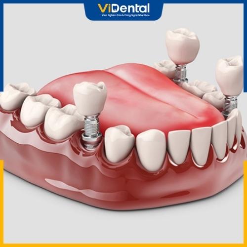Trồng răng Implant trả góp được nhiều khách hàng ưa chuộng