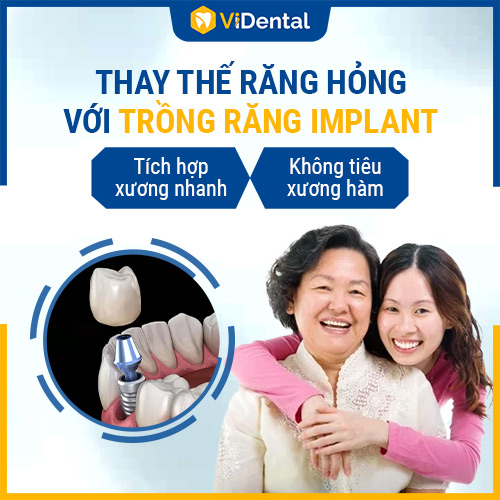 Trồng răng Implant là phương pháp hiệu quả nhất trong chỉnh nha