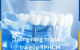 Trồng Răng Implant Trả Góp TPHCM: Điều Kiện Và Địa Chỉ Uy Tín