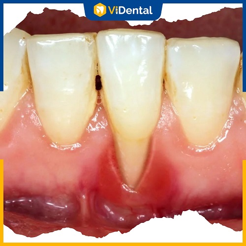 Tình trạng tụt lợi dễ xảy ra nếu bọc răng sứ kém chất lượng