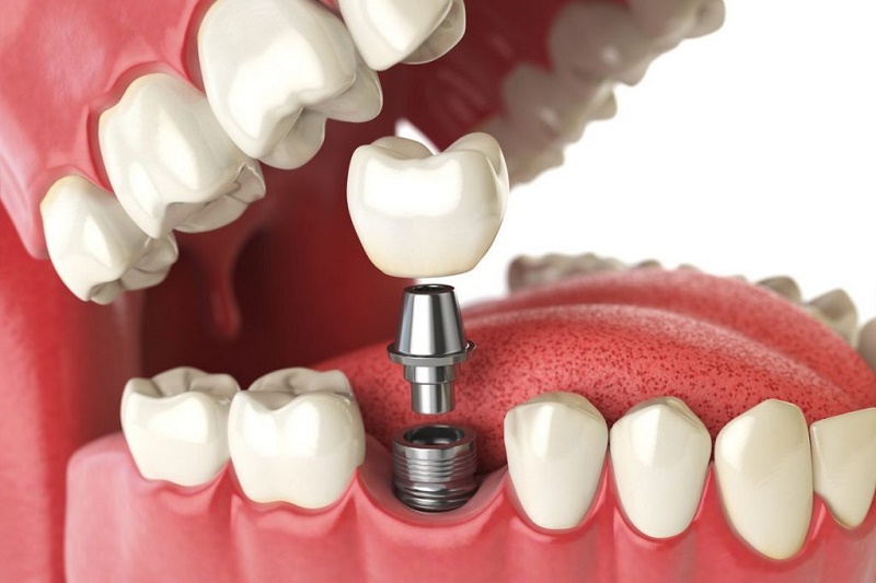 Những lợi ích và rủi ro của việc trồng răng implant mà khách hàng cần biết?
