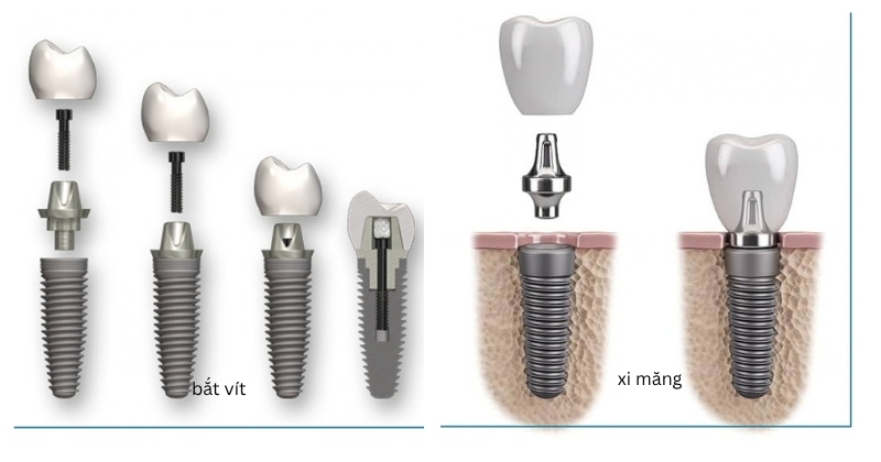 2 phương pháp phục hình răng sứ trên implant