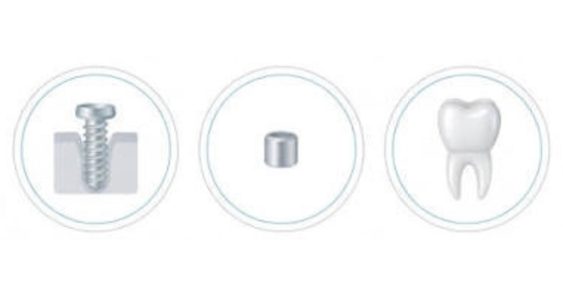 3 thành phần cấu tạo nên chi phí trồng răng Implant