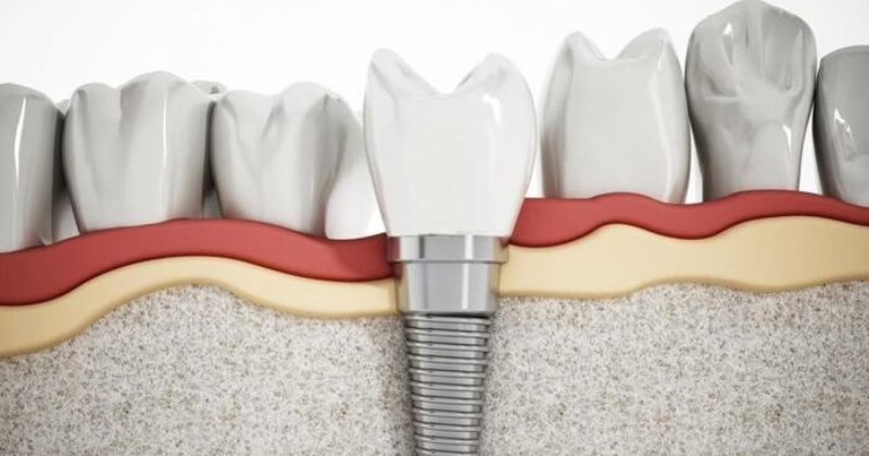 Các giải pháp giúp mất răng lâu năm cắm Implant thành công cao