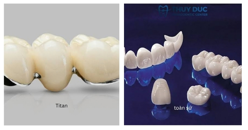 Các loại mão răng sứ phổ biến lắp trên trụ implant
