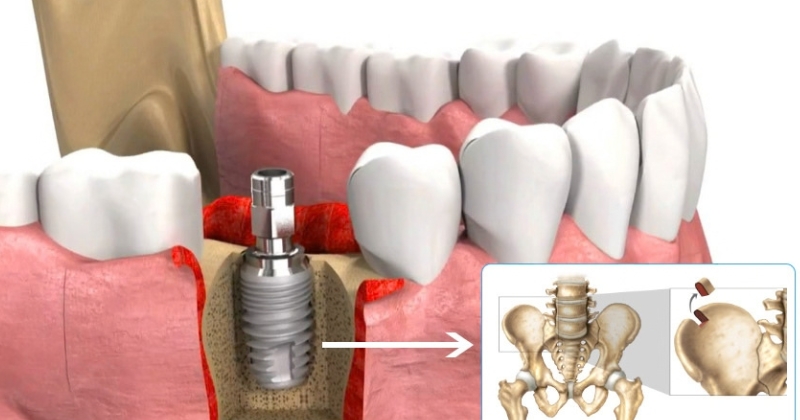 Các loại xương dùng trong phẫu thuật ghép xương implant
