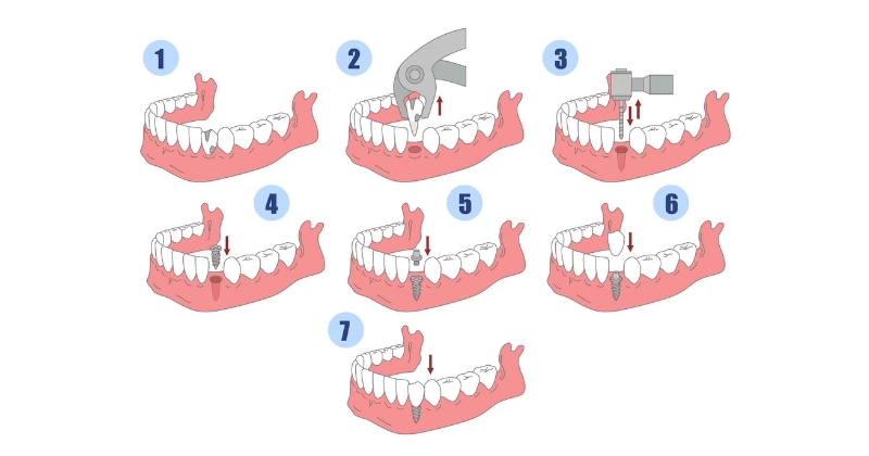 Các nguyên tắc đảm bảo cấy Implant an toàn