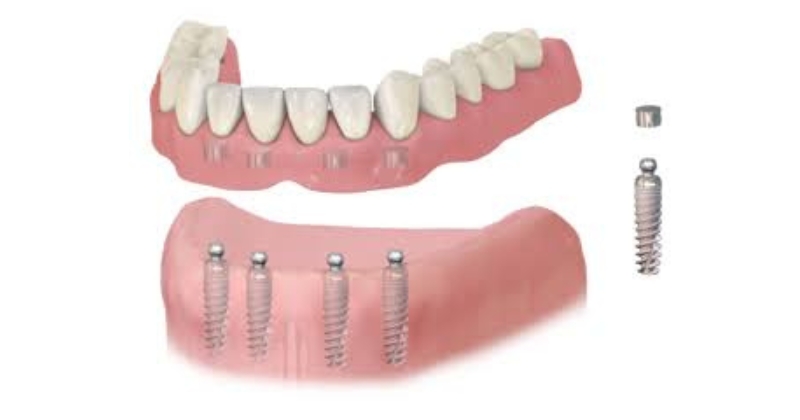 Cấu tạo của hệ thống hàm tháo lắp trên implant
