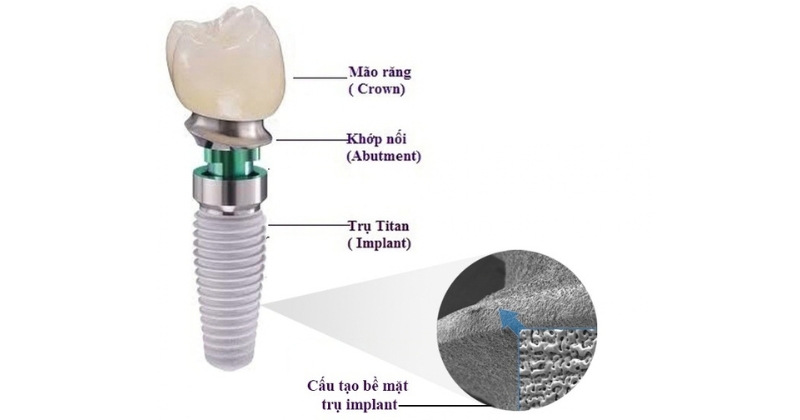 Cấu tạo hoàn chỉnh của một răng implant