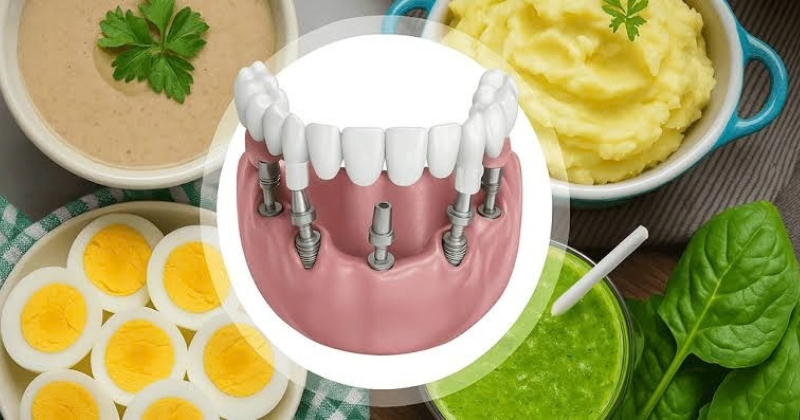 Chế độ dinh dưỡng_ Nên ăn gì và kiêng gì sau khi cấy implant