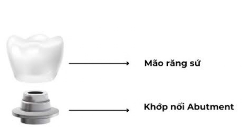 Chi phí khớp nối & mão răng sứ