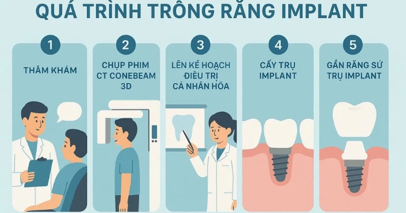 Chi tiết quy trình 5 bước cắm Implant chuẩn y khoa