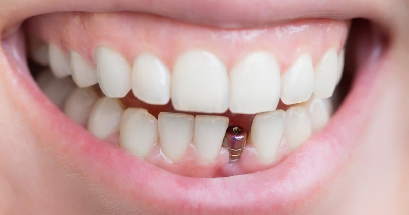 Có nên trồng răng implant không