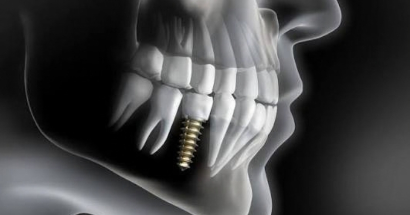 Đánh giá chuyên khoa_ Trồng răng implant có nguy hiểm không