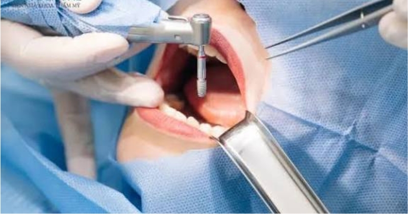Ghép xương implant có đau không_ Có nguy hiểm không