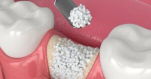 Ghép xương implant là gì