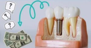 Giá trồng răng Implant 202
