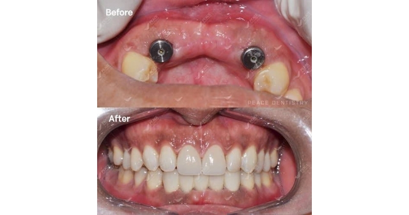 Giải pháp kỹ thuật tối ưu khi trồng răng implant răng cửa