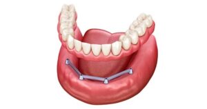 Hàm tháo lắp trên implant là gì