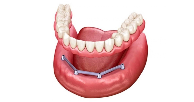 Hàm tháo lắp trên implant là gì