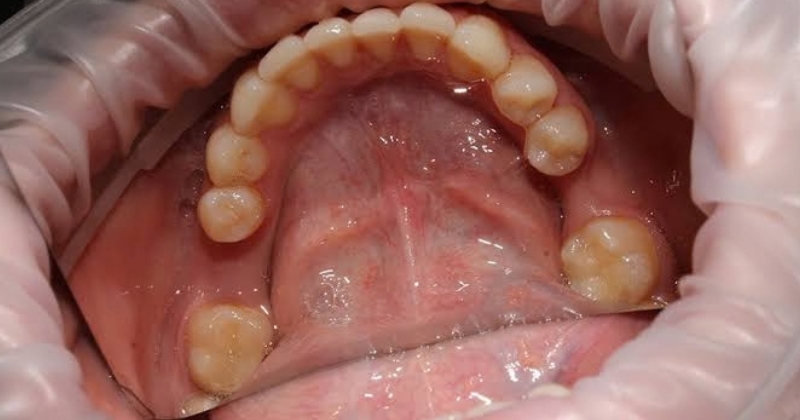 Hậu quả nguy hiểm nếu để mất răng quá lâu mới trồng Implant