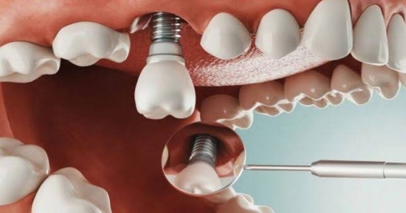 Implant là gì và trồng răng implant là gì