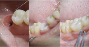 Implant nha khoa phục hình răng mất