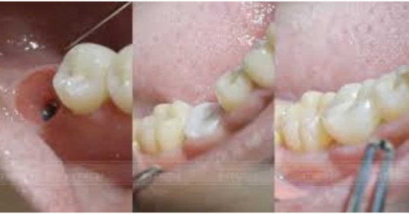 Implant nha khoa phục hình răng mất