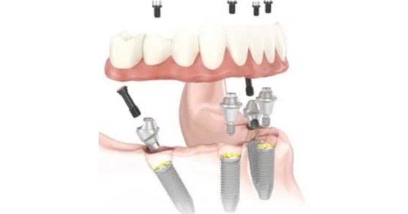Kinh nghiệm chọn loại trụ implant phù hợp
