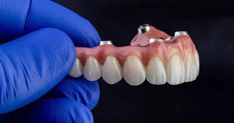 Kỹ thuật trồng răng Implant all on 4