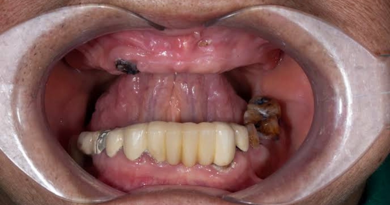 Làm gì khi bị mất răng lâu năm
