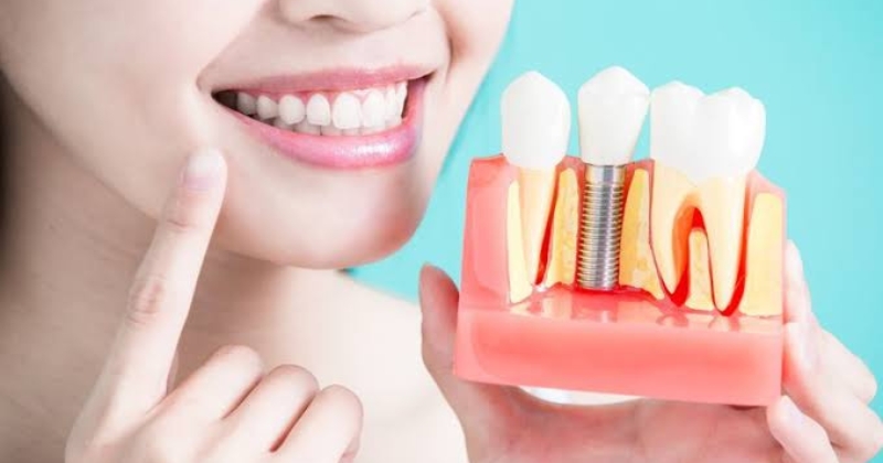 Làm thế nào để trồng Implant ngay sau khi nhổ răng
