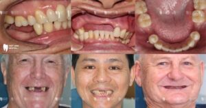 Mất răng lâu năm có trồng implant được không