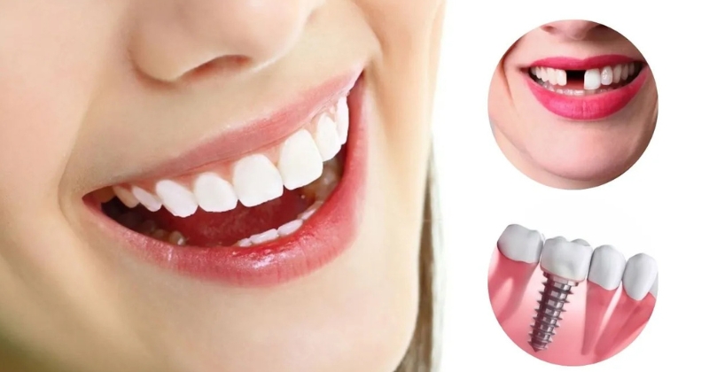 Mẹo mách bạn cách rút ngắn thời gian cấy ghép Implant an toàn