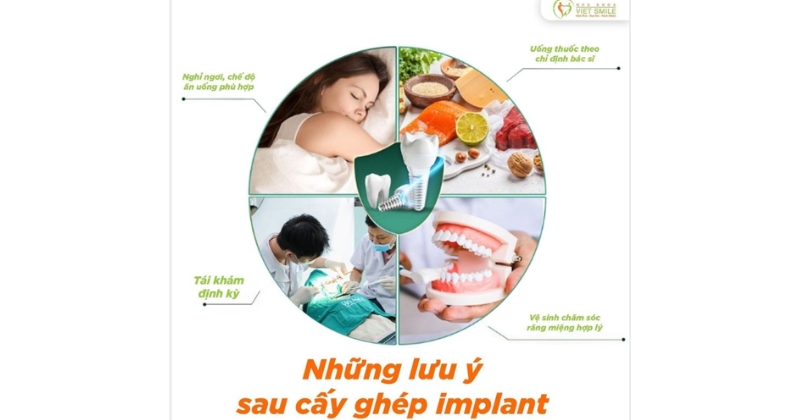 Những lưu ý quan trọng sau khi hoàn thành quy trình trồng răng Implant