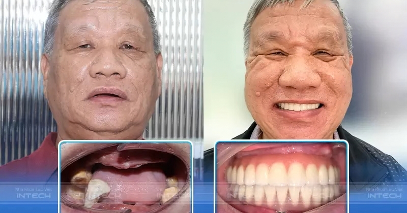 Những thách thức khi trồng răng Implant cho người mất răng lâu năm