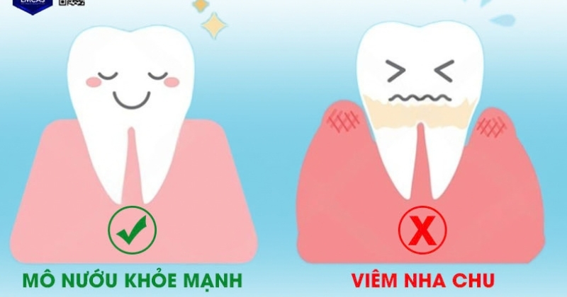 Những tiêu chí bắt buộc để đảm bảo quy trình cắm Implant an toàn