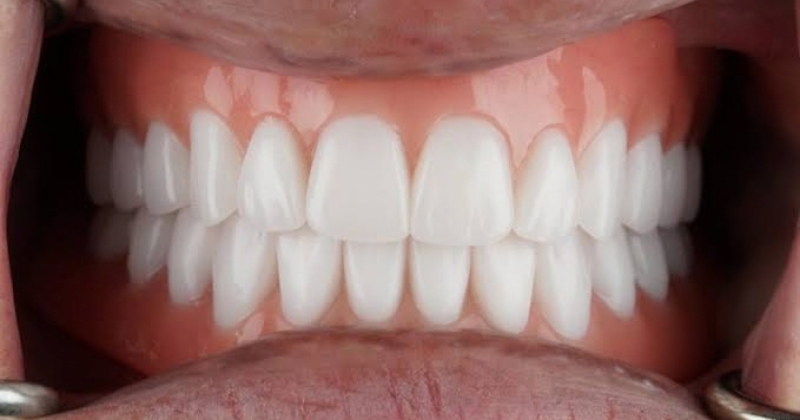 Những yếu tố quyết định làm răng implant có đau hay không
