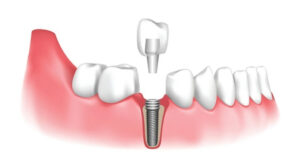 Phục hình răng sứ trên implant