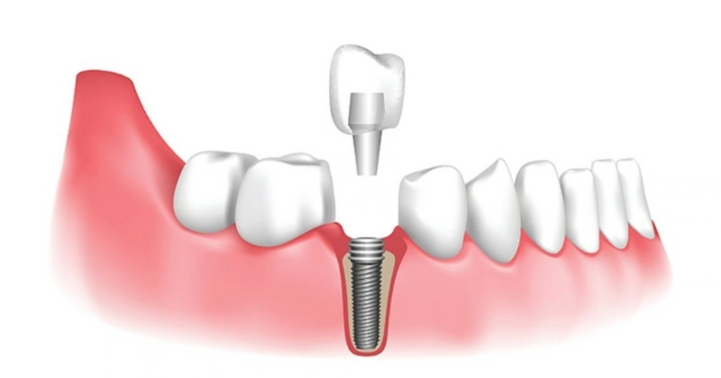 Phục hình răng sứ trên implant