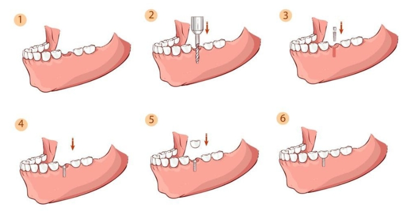 Quy trình cắm implant chuẩn y khoa an toàn và không đau