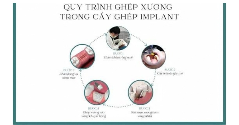 Quy trình ghép xương implant chuẩn y khoa