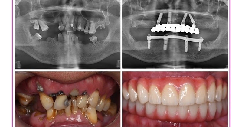 Quy trình phục hình răng sứ trên implant