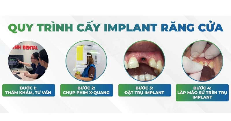 Quy trình trồng implant răng cửa chuẩn thẩm mỹ 5 bước