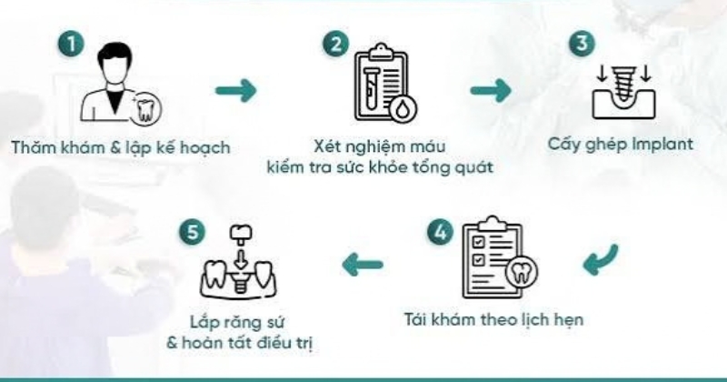 Quy trình trồng răng Implant cho người mất răng lâu năm mất bao lâu