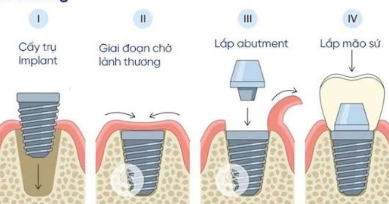 Quy trình trồng răng Implant mất bao lâu