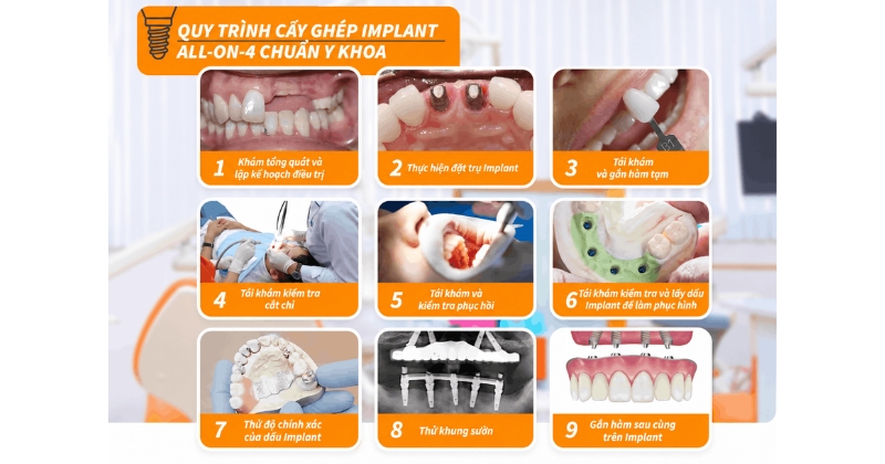 Quy trình trồng răng implant nguyên hàm
