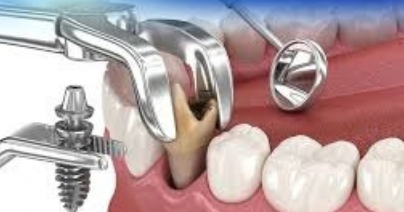 Sau khi nhổ răng bao lâu thì trồng Implant nhanh và an toàn