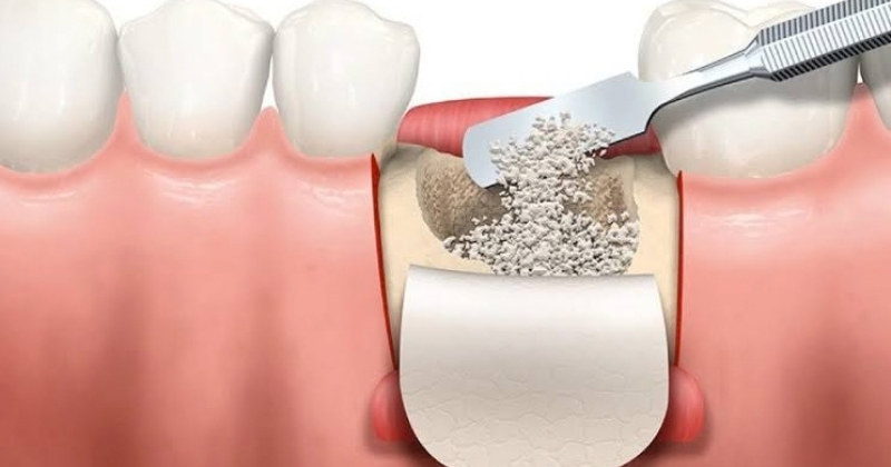 Tại sao phải ghép xương khi trồng răng implant